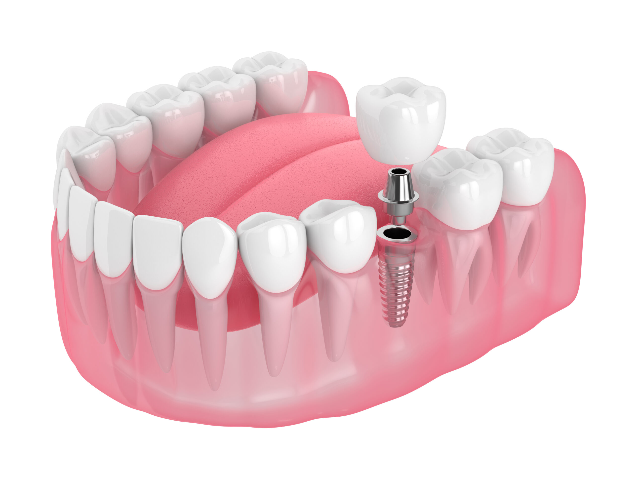 Harrick Plasma 用於 dentistry 牙科材料表面處理